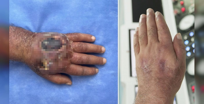 İstanbul'da hırsız ısırması: Kol kesilmekten kurtarıldı