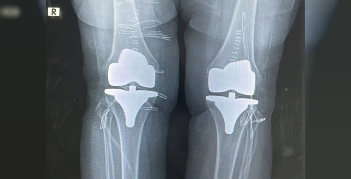 Bayburt'ta 73 yaşındaki hastanın diz ağrıları giderildi