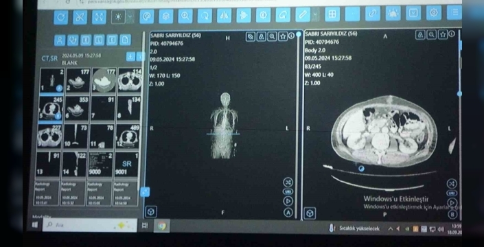 Yapay zekâ, Van'da kanser tedavisinde devrede: Hekimlerle %76 oranında örtüşen kararlar