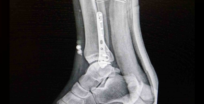 Uzman uyardı: Herkes her sporu yapamaz, kontrolsüz spor sakatlığa davetiye çıkarıyor