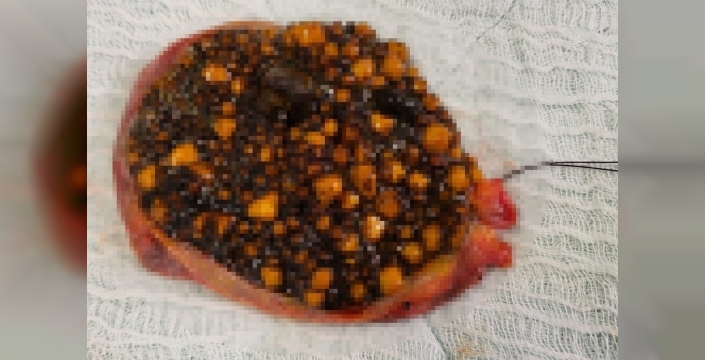 Karın ağrısıyla hastaneye giden kadının safra kesesinden binlerce taş çıkarıldı