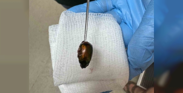 Kulağına kaçan Japon böceği çiftçinin hayatını kabusa çevirdi, doktorlar şaşkına döndü!
