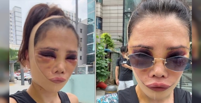 Didem Ceran, yüz nakli sonrası yaşadığı şikayetlere gözyaşlarıyla yanıt verdi