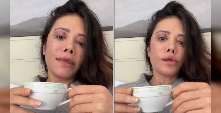 Didem Ceran, estetik operasyonlarına devam ediyor